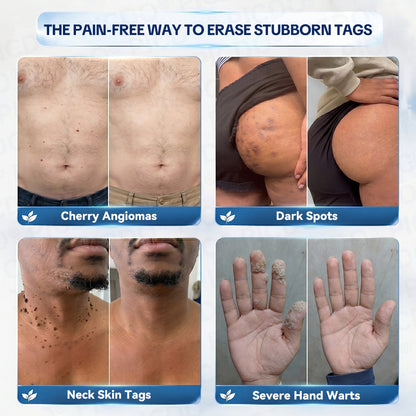 𝐏𝐢𝐜𝐝𝐨® 7-𝐃𝐚𝐲 𝐒𝐤𝐢𝐧 𝐓𝐚𝐠 & 𝐒𝐩𝐨𝐭 𝐄𝐫𝐚𝐬𝐞𝐫 𝐂𝐫𝐞𝐚𝐦🩵 (Zero Pain, Zero 𝐒𝐜𝐚𝐫𝐬 Formula) 💎