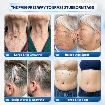 𝐏𝐢𝐜𝐝𝐨® 7-𝐃𝐚𝐲 𝐒𝐤𝐢𝐧 𝐓𝐚𝐠 & 𝐒𝐩𝐨𝐭 𝐄𝐫𝐚𝐬𝐞𝐫 𝐂𝐫𝐞𝐚𝐦🩵 (Zero Pain, Zero 𝐒𝐜𝐚𝐫𝐬 Formula) 💎