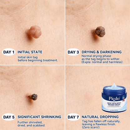 𝐏𝐢𝐜𝐝𝐨® 7-𝐃𝐚𝐲 𝐒𝐤𝐢𝐧 𝐓𝐚𝐠 & 𝐒𝐩𝐨𝐭 𝐄𝐫𝐚𝐬𝐞𝐫 𝐂𝐫𝐞𝐚𝐦🩵 (Zero Pain, Zero 𝐒𝐜𝐚𝐫𝐬 Formula) 💎