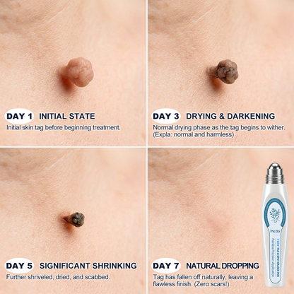 𝐎𝐟𝐟𝐢𝐜𝐢𝐚𝐥 𝐁𝐫𝐚𝐧𝐝 𝐒𝐭𝐨𝐫𝐞 |🧿𝐏i𝐜𝐝o® 7-𝐷𝑎𝑦 𝗧𝐚𝐠 & 𝗦𝗽𝐨𝐭 𝐄𝐫𝒂𝒔𝒆𝒓(Zero Pain, Zero 𝐒𝐜𝐚𝒓𝒔 Rollerball)💠