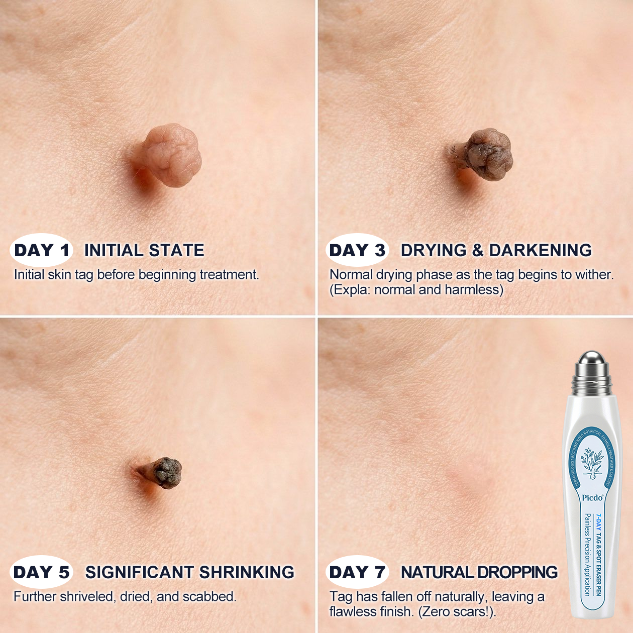 𝐎𝐟𝐟𝐢𝐜𝐢𝐚𝐥 𝐁𝐫𝐚𝐧𝐝 𝐒𝐭𝐨𝐫𝐞 |🧿𝐏i𝐜𝐝o® 7-𝐷𝑎𝑦 𝗧𝐚𝐠 & 𝗦𝗽𝐨𝐭 𝐄𝐫𝒂𝒔𝒆𝒓(Zero Pain, Zero 𝐒𝐜𝐚𝒓𝒔 Rollerball)🐬
